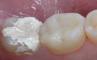 Непоседливая «времянка» – что делать до обращения к врачу, когда выпала пломба