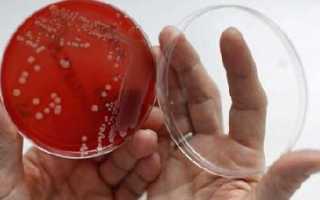 Признаки, факторы развития и способы лечения гарднереллеза у женщин