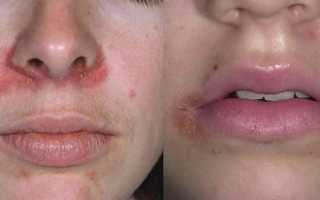 Что такое атопический дерматит и как его быстро вылечить?