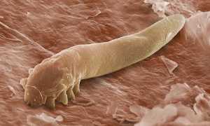 Демодекоз у человека на лице. Симптомы, признаки, проявления