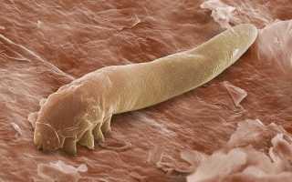 Демодекоз у человека на лице. Симптомы, признаки, проявления