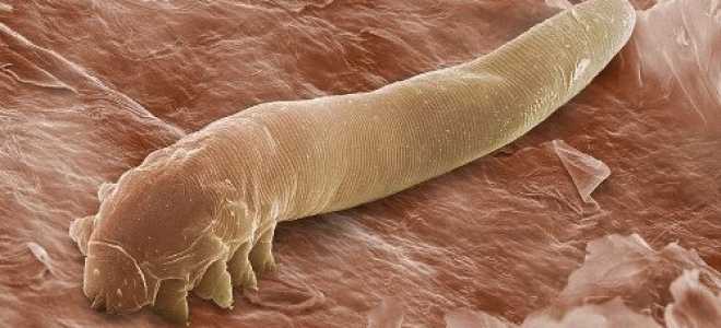 Демодекоз у человека на лице. Симптомы, признаки, проявления