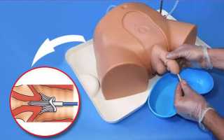 Остаточная моча в мочевом пузыре у женщин