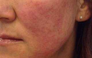 Пятна на лице красного цвета. Шелушатся участки кожи. Лечение кожи