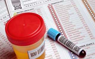 Как делают анализ трехстаканной пробы мочи