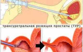 Операция тур аденомы простаты цена в москве