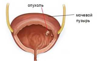 Как обнаружить рак мочевого пузыря у женщин и какие особенности этой болезни?