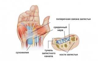 Туннельный синдром (запястного канала): причины, симптомы и лечение