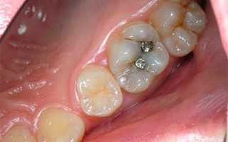 Важность своевременного выявления и устранения скрытого кариеса