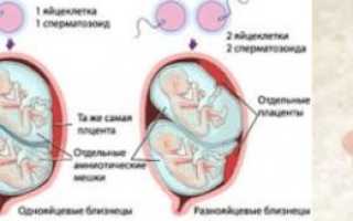 Признаки многоплодной беременности на ранних сроках