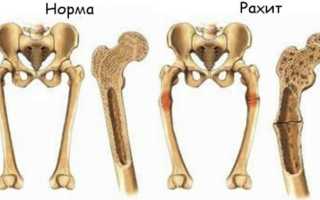 Аппарат Илизарова на руке: установка, снятие и восстановление тканей, сроки применения