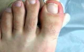 Приготовление мази от вросшего ногтя в домашних условиях