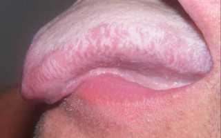 Лейкоплакия слизистой оболочки полости рта и языка: формы лейкоплакии, причины, симптомы, лечение