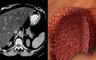 Стеатогепатоз: что это такое и как его лечить? Лечение и диета при стеатогепатозе