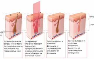 Лазерная эпиляция ушей для мужчин и еще 6 зон на мужском теле