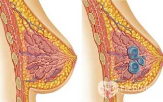 Атипичная и типичная киста молочной железы — в чем разница?