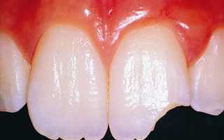 Что делать, если появились трещины на зубах? Причины и лечение