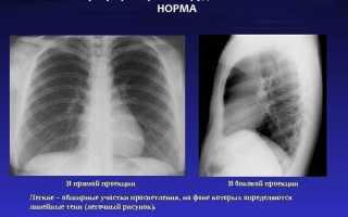 Можно ли делать флюорографию при грудном вскармливании и как лучше ее проходить кормящей матери?