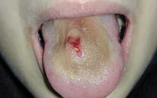 Пузырьки под языком. Появился кровяной пузырь под языком