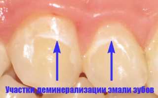 Деминерализация, или почему сладкое вредно для зубов