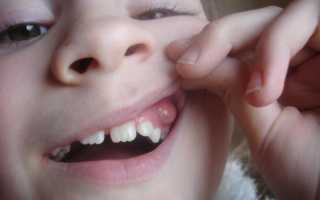 Диагностика и лечение поражений полости рта у новорожденных