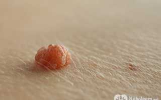 Радиоволновое удаление родинок – будущее уже здесь!