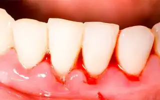 Кровоточивость десен у детей: причины, лечение, профилактика