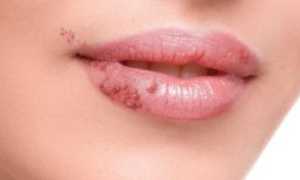 Эксфолиативный хейлит: причины, симптомы, диагностика и лечение