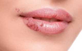 Эксфолиативный хейлит: причины, симптомы, диагностика и лечение