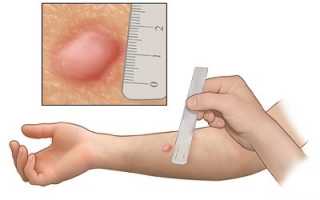 До 7 лет — проба Манту, потом – Диаскинтест. Это приказ