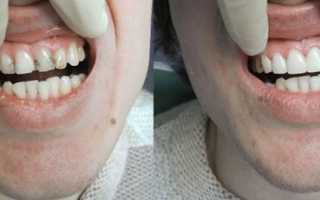 Больно ли лечить кариес без анестезии (фото и видео)