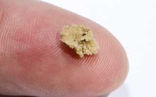 Низкоинтенсивный лазер в урологии лечение камней предстательной железы