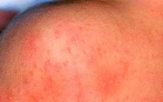 Лечение аллергического дерматита у взрослых, симптомы и профилактика