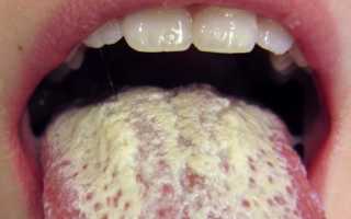Способы лечения грибка на языке медицинскими и народными методами