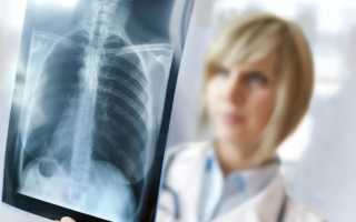 Чем опасна флюорография при беременности на всех сроках и зачем ее делать после родов