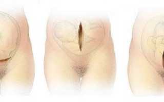 Шов после кесарева сечения. Почему болит шов после кесарева сечения? Сколько заживает шов после кесарева? Чем обрабатывать?