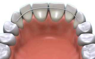 После брекетов разъехались зубы — красота улыбки под угрозой