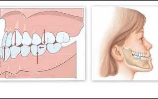 Влияние мезиального прикуса на ваше здоровье и привлекательность