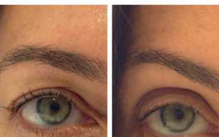 Как убрать птоз верхнего века после ботокса: лечение