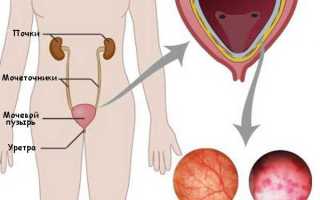 Урологические центры в москве лечение цистита