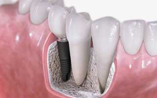 Какие конструкции имплантов зубов предлагают израильские разработчики