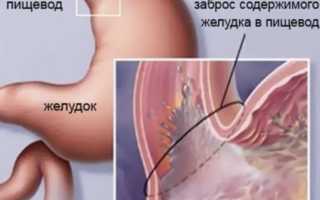 Изжога каждый день — что делать. Причины и лечение изжоги