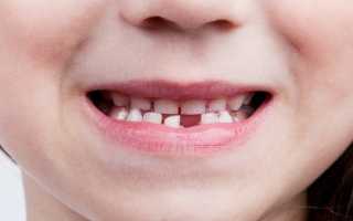 Что делать, если у ребенка начали выпадать молочные зубы