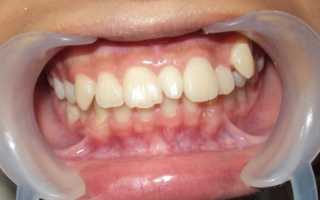 Стоматология детского возраста — Персин9 / Раздел 13. Ортодонтия / 13.08.6. Аномалии положения зубов