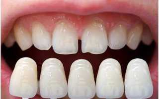 Металлокерамика или цирконий – чем они отличаются и что лучше выбрать?