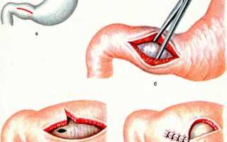 Пилоростеноз: симптомы, диагностика и лечение (операция, восстановление)