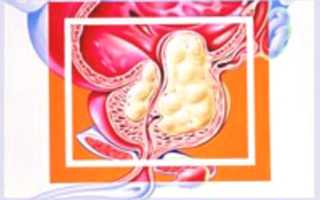 Баллонная дилатация: показания, противопоказания, применение