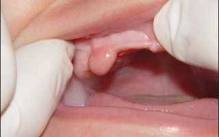 Что делать с шишкой на десне после удаления зуба. Промедление грозит остеомиелитом