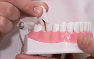 Мост или имплант? Выбираем оптимальный метод восстановления зуба