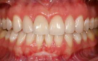 Как выбрать гель для дёсен при воспалении? Рассматриваем эффективные средства